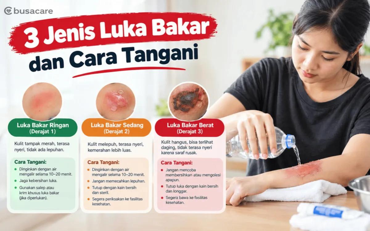 3 Jenis Luka Bakar dan Cara Penanganan yang Benar